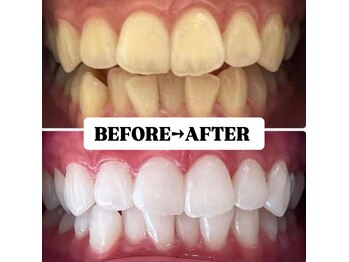 ホワイトニングサロン 豊中/Before&After美白ホワイトニング