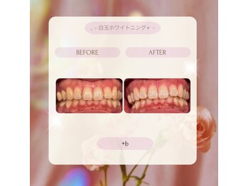 プラスビー 2号店(+b)/ホワイトニングビフォーアフター