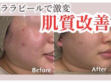 シー センター北(sii)/ララピールで肌質改善