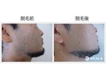 メンズ脱毛サロン アカラ(AKALA)/ヒゲのビフォーアフター