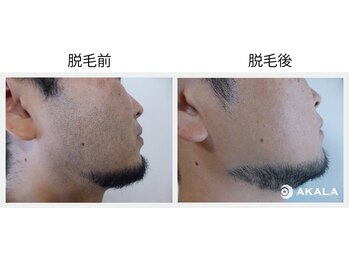 メンズ脱毛サロン アカラ(AKALA)/ヒゲのビフォーアフター