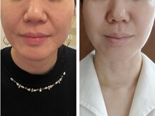 ビューティフルムーン(Beautiful Moon)/小鼻縮小&ほうれい線も薄く