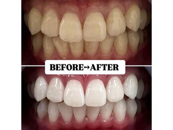 ホワイトニングサロン 豊中/Before&After美白ホワイトニング