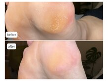 カシェット(Cachette)/40代女性◎足裏角質ケア90分