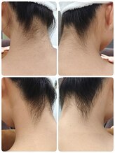 エステシェービングサロン フルール(Fleur)/うなじのシェービング