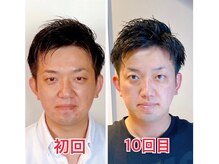 小顔22 ボルティ 赤坂支店(Bolty)/30代：小顔シンメトリー（10回）