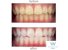 ホワイトニングショップ 山口店/山口ホワイトニング