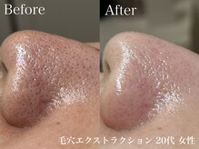 フレーズ(fraise)の雰囲気（毛穴エクストラクションとホームケアで根本を改善！）