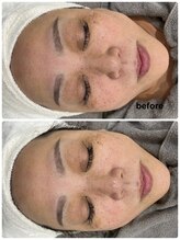 ウェイビーズ エステ(wavy's.esthetic)/【ビフォーアフター】赤味改善