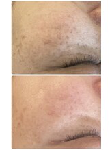 イノエ(inoe)/【シミ、くすみ、毛穴】