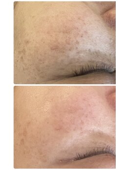 イノエ(inoe)/【シミ、くすみ、毛穴】