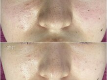 バタフライ 津田沼店(Butterfly)/Butterflyのハーブピーリング