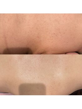 ミューズ(MUSE)/背中ハーブピーリング