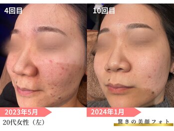 トレース/美顔フォトを1年間続けた効果