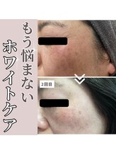 ヴィヴィエ 佐賀店(ViVier)/ホワイトケア症例　２回