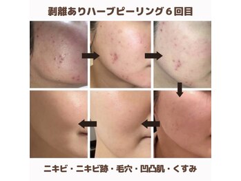 アイル 代々木上原店(iru)/ハードハーブピーリング6回目