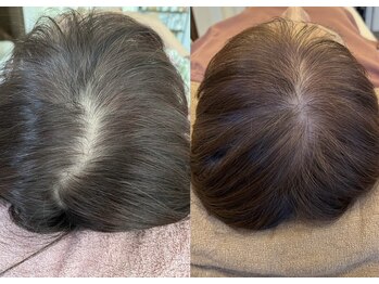 ココシア(CoCosia)の写真/最新鋭マシーン導入！頭皮の毛穴にアプローチし、育毛を促進◎美髪を目指すあなたに、理想的なケアを提供♪