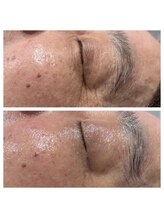 じぶんniプラス/常滑/フェイシャル/シミ/たるみ