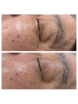 じぶんniプラス/常滑/フェイシャル/シミ/たるみ