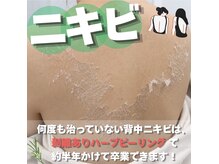 カナウ(KANAU)の雰囲気（何年も改善してない背中ニキビには【剥離ありハーブピーリング】）