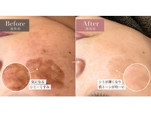 アクラフ 北千住(akurah)の雰囲気（【REVIVE】2回施術+インテンシブホワイト）
