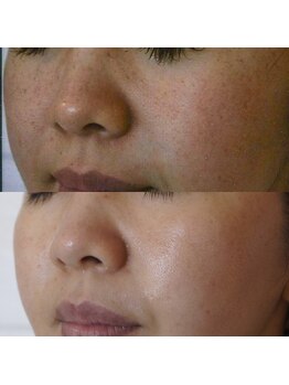 トラット エステアンドアイズ(tratto)/30代　お客様症例写真