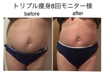 ビューティーサロン ルクール エステ(beauty salon le Coeur Este)/トリプル痩身　before・after
