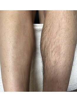 フロー(FLOW)/メンズ 脚脱毛