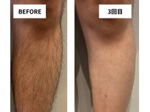 イム(im)/men's全身脱毛