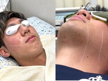 和歌山ビューティー アガ(AGA)の写真/都度払い脱毛スタート！42年の実績サロンの都度払い脱毛コースです！ムダ毛のお悩みに寄り添います！