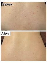 メロー(MELLOW)/背中ニキビケア/黒ずみ/ざらつき