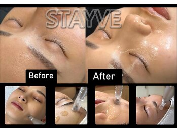 サロンフィーユ(Fille)/韓国生美容液導入STAYVE