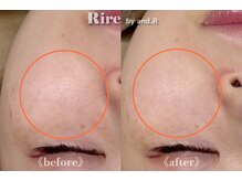 リル バイ アンドアール(Rire by and.R)/イオン導入×美白トリートメント