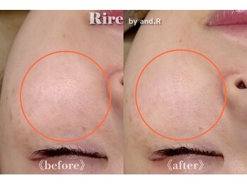 リル バイ アンドアール(Rire by and.R)/イオン導入×美白トリートメント