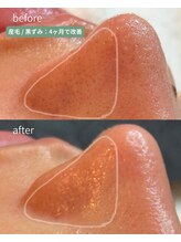 翡翠/小鼻の黒ずみ四ヶ月で改善