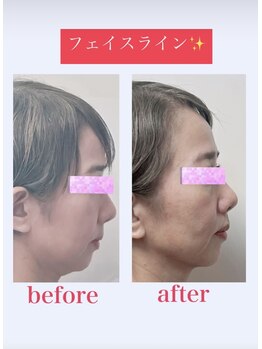 ブロッサム 山内店/フェイスリリース☆50代効果