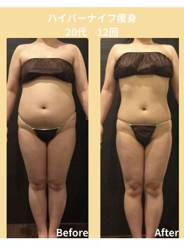 タノソイネ(tanosoine)/【20代/ハイパーナイフ痩身】