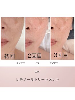 リアン(Lien)/50代 ビフォーアフター