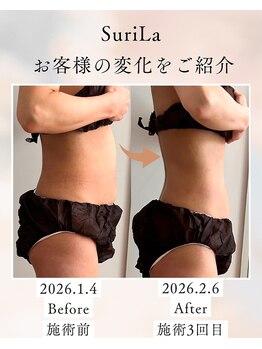 スリラ(SuriLa)/◆ビフォーアフター◆（3回目）