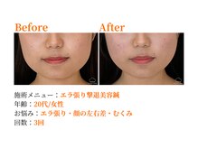 シルエラバレ(CiruelaValle)/Before After