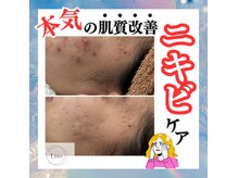 リノ(Lino)の雰囲気（〈6~10回〉ニキビで長年お悩みの方へ!フェイシャル/毛穴/小顔）
