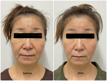 まろん鍼灸接骨院 立川店/美容鍼　Before→After！