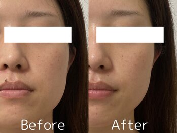 キーオブフェイス(Key of Face)/お悩み【頬のたるみ】