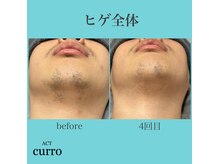 アクト クロ(ACT curro)/【ヒゲ全体】脱毛施術例