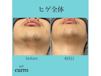 アクト クロ(ACT curro)/【ヒゲ全体】脱毛施術例