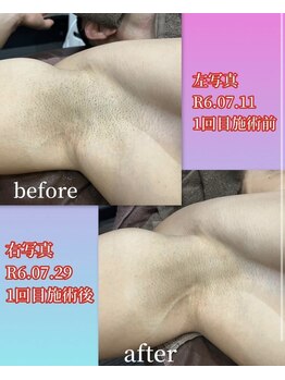 バーン 長崎 諫早(BURN)/脱毛ビフォーアフター☆