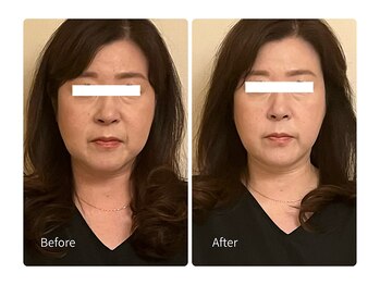 ベルソー(Berceau)/小顔矯正