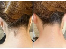 ノア(NOA.)/【美肌全身脱毛】美肌改善プラン