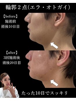 ダウンタイムオンニ(DowntimeOnni)/頑固なダウンタイムも!