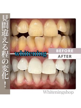 ホワイトニングショップ 加古川店の写真/とにかく早く白くしたい！時間がない！夏までに！そんな方におすすめ★集中コースで驚きの白さに♪